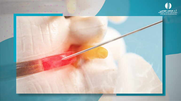 شــفط وتـبـخير الغـضـروف العــنقي والقــطني بالــتـردد الحــراري بدون جــراحة أو ألـم نهائياً .