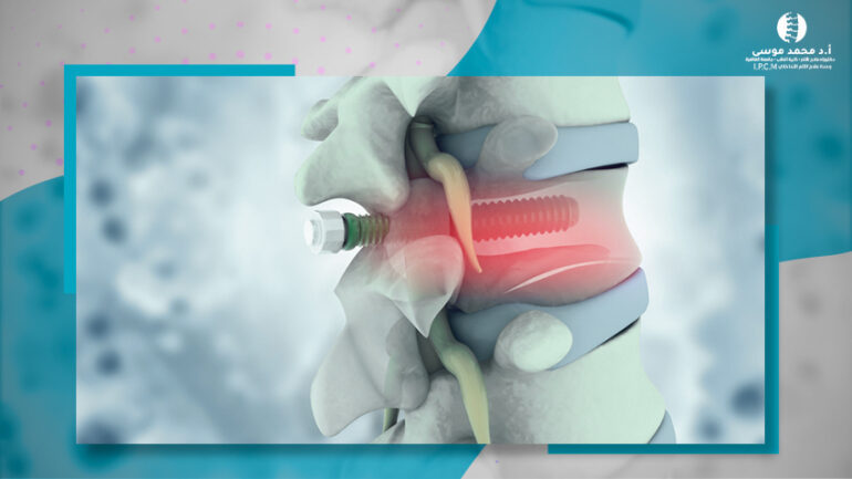 علاج ضيق القناه العصبيه والتنميل والخذل بالتردد الحرارى